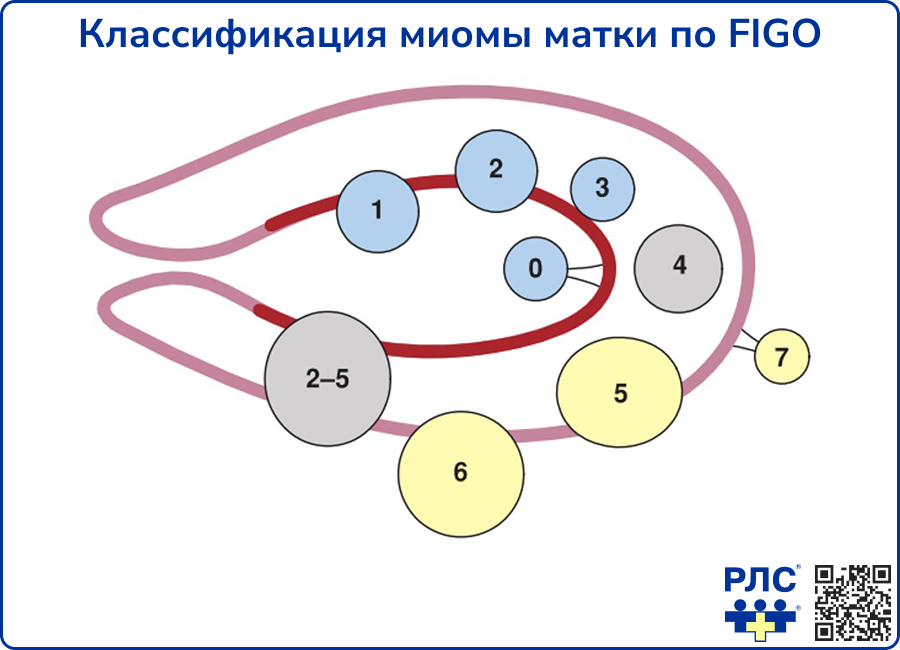 Классификация миомы матки по FIGO